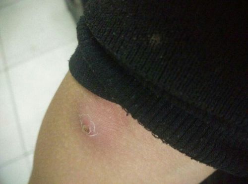 疖子熟了吗能挤了吗