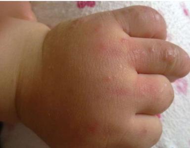 宝宝皮肤过敏的症状 宝宝皮肤过敏的原因