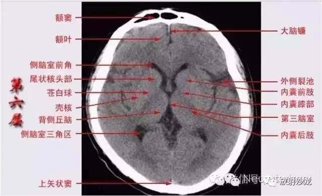 【推荐】头颅ct的断层解剖——全是图