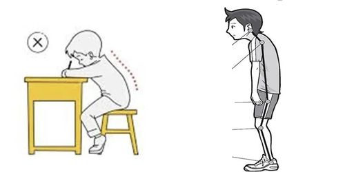 驼背低龄化倾向明显,家长勿轻视孩子的体态_驼背_运动