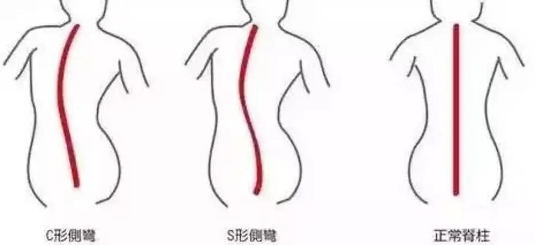 如何判断自己有脊柱侧弯的症状.