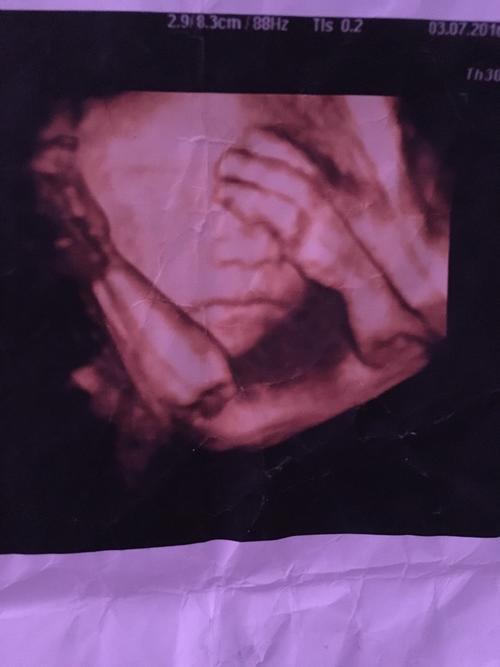 宝妈们会看三维胎儿照片吗?我怎么没看见宝宝的眼睛呢