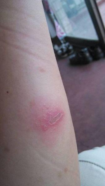 这是什么虫子咬伤的,该如何治理这种虫子.