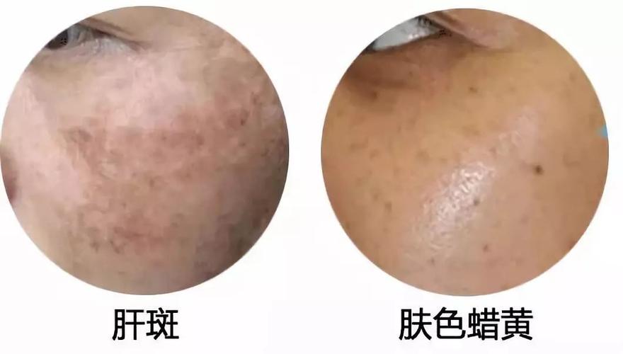 1-2个月也会重新长出新的 "肝斑"