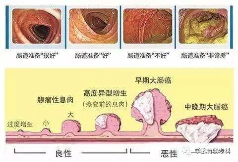 (包括乳头状腺瘤)最常见,炎性息肉,肠粘膜受长期炎症刺激增生的结果
