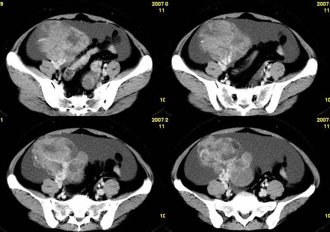 卵巢囊腺癌(ovarian cystadenocarcinoma)ct病例(图文