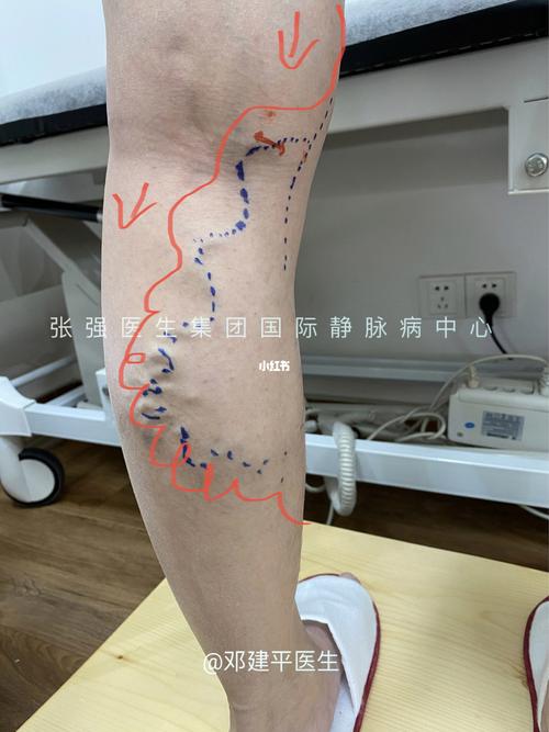 乍一看可能以为是小隐静脉曲张,实际上是来自前面的大隐静脉反流_静脉