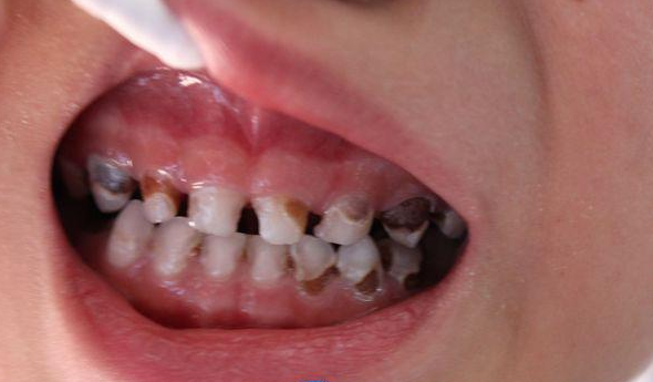 儿童蛀牙图片 (26)