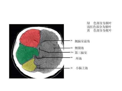 绿 色部分为颞叶 浅红色部分为额叶 黄 色部分为枕叶 侧脑室前角 侧裂
