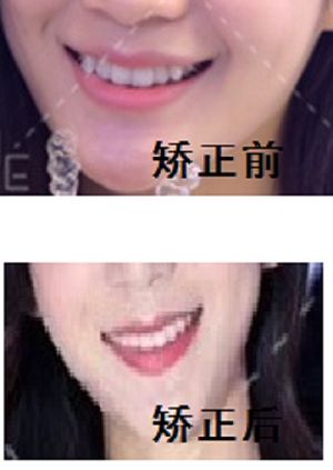小虎牙要不要做矫正呢?(附上深圳美莱小姐姐矫正前后