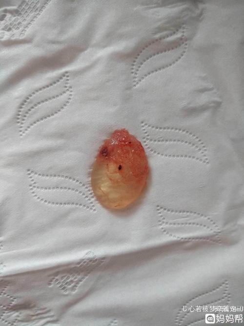 药流,这个是不是孕囊啊!