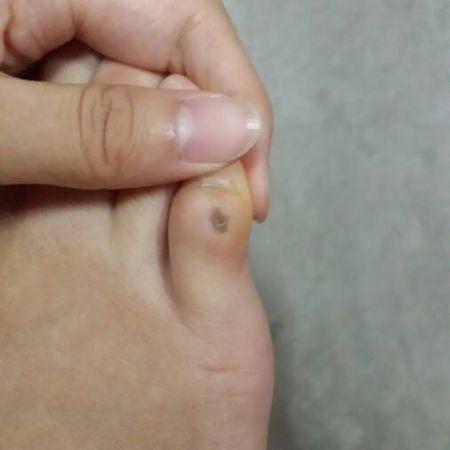 小脚趾被鞋磨出一个小茧子,手贱,扣掉了.两三天后发现