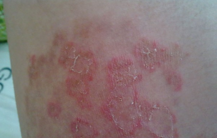 真菌皮肤病怎么治 根据病因选取最佳方法