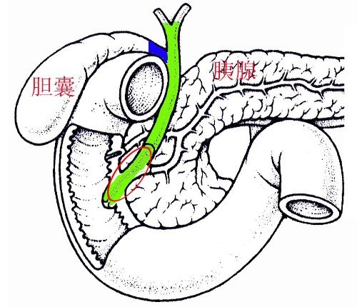 胆总管扩张的治疗方法