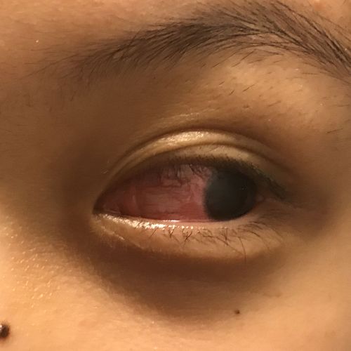 眼睛疼痛 感觉有异物 看东西有点模糊 偶尔痒 看见比较亮的光会很疼