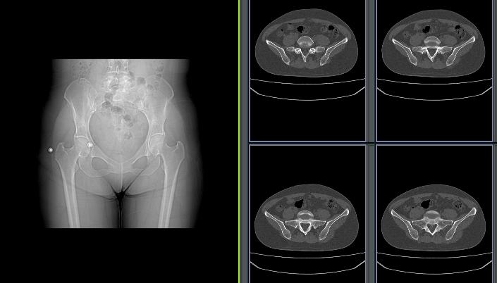 骨盆,股骨头平扫