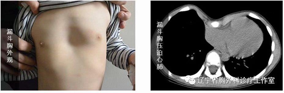 新式漏斗胸矫正术