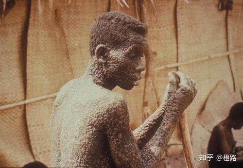 黑死病大概造成全世界7500万人死亡,其中欧洲死亡人数将近4000万.