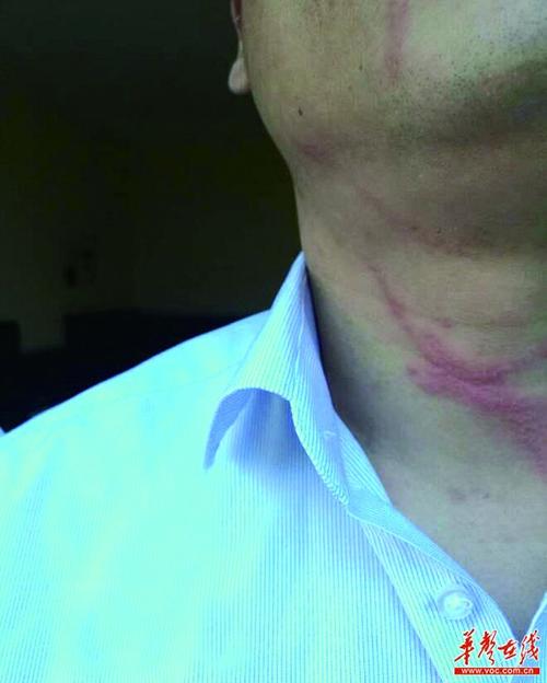 最近隐翅虫频现 长沙多人"中招"进医院