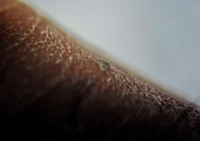 恐怖!显微镜下的皮肤和脂肪粒