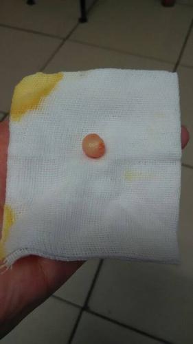 我头上长了一个小粉瘤.今天割掉了.请专业人士帮我看看割得完不完整?