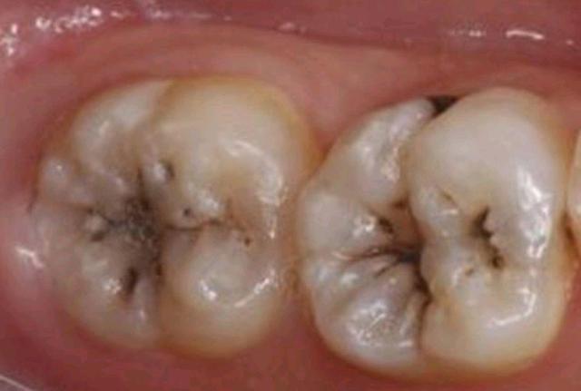 牙齿表面黑色的点或线段就是窝沟龋啦