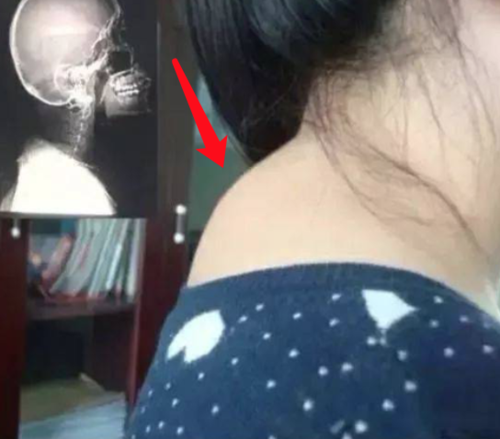脖子后的"富贵包"会夺命!真相还是谣言?