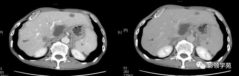 脾脏正常ct及常见疾病影像表现