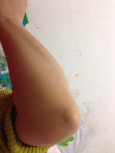 手肘关手肘关节寸许位置有一软肿块五月余