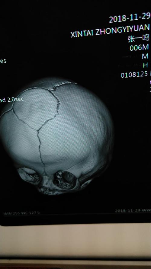 颅缝早闭,狭颅症,我的宝宝必须要做手术吗?