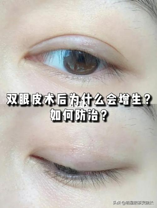 双眼皮术后为什么会增生?如何防治?