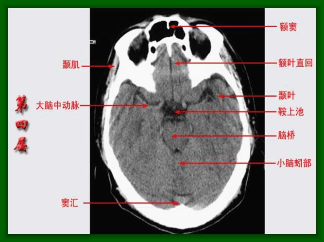 医学急救:头颅ct解剖图片