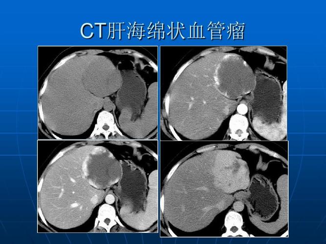 ct肝海绵状血管瘤