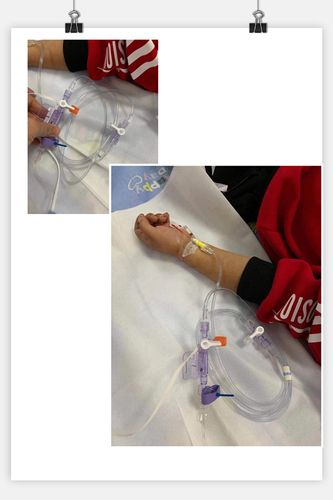 凉山州第一人民医院儿科已成功开展有创动脉血压监测及中心静脉导管置