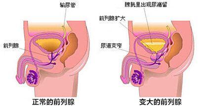 尿急尿频是怎么回事,夜尿多是怎么回事?是它有了麻烦!