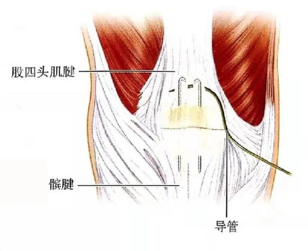 骨科小技巧髌骨骨折手术技巧