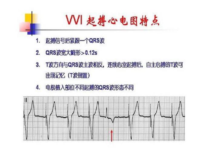 起搏器心电图分析ppt
