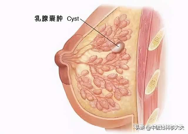 没运气长个大胸,却长了乳腺囊肿,会癌变吗?