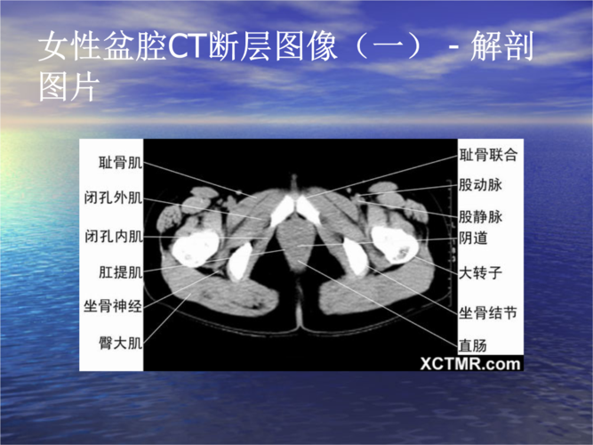 盆腔ct诊断精要.ppt