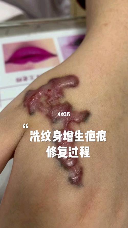 洗纹身增生疤痕_纹身_疤痕_疤痕修复_美妆_医美整形