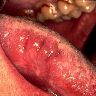 展开全部 艾滋病患者舌头发病图片 向左转  向右转