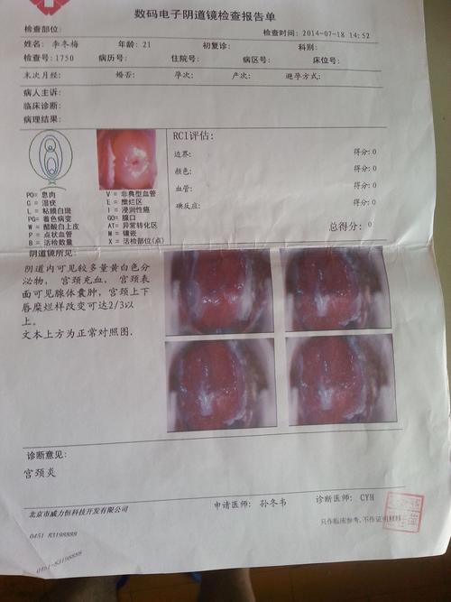 我女朋友宫颈糜烂,请专业医生指点