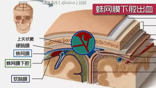 男子沉迷网游被"爆头" 去医院被诊:蛛网膜下腔出血