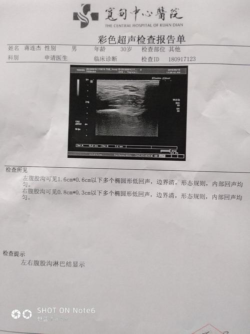 腹股沟能摸到淋巴结,感觉比黄豆粒小一些,附上彩超检查报告,哪位大神