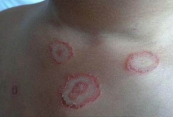 铜钱癣的病因几种去癣方法必看