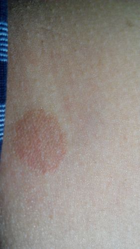 腿内侧长了个圆形小红斑,像胎记,不疼不痒不凸起,发现时有黄豆大小
