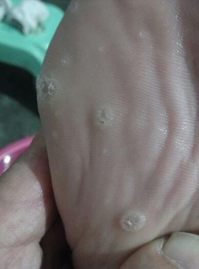 脚底2012年一边长了一个类似鸡眼的硬疹,三年多了,越来越多,我好担心