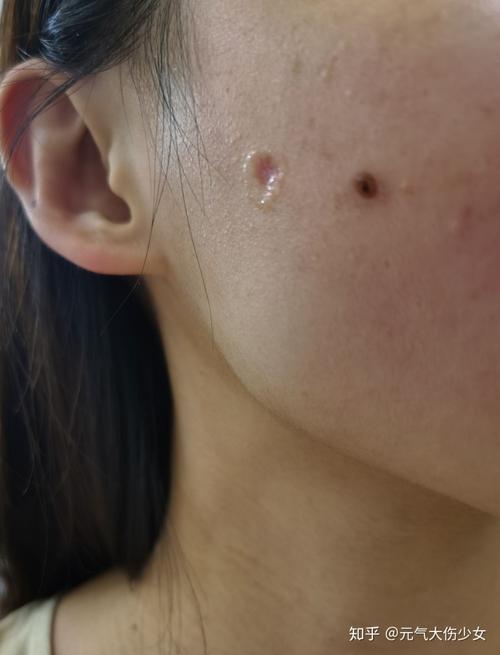 上海九院激光点痣祛痣记录