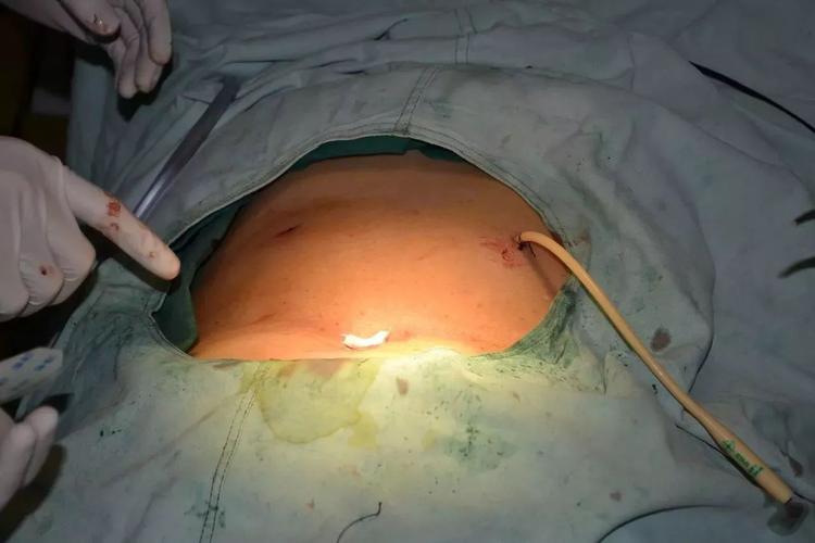 微创手术--腹部切口