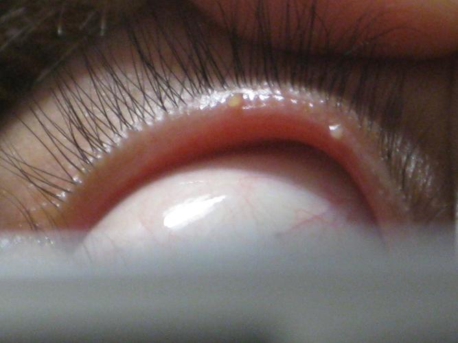 睑板腺功能障碍该用些什么药?